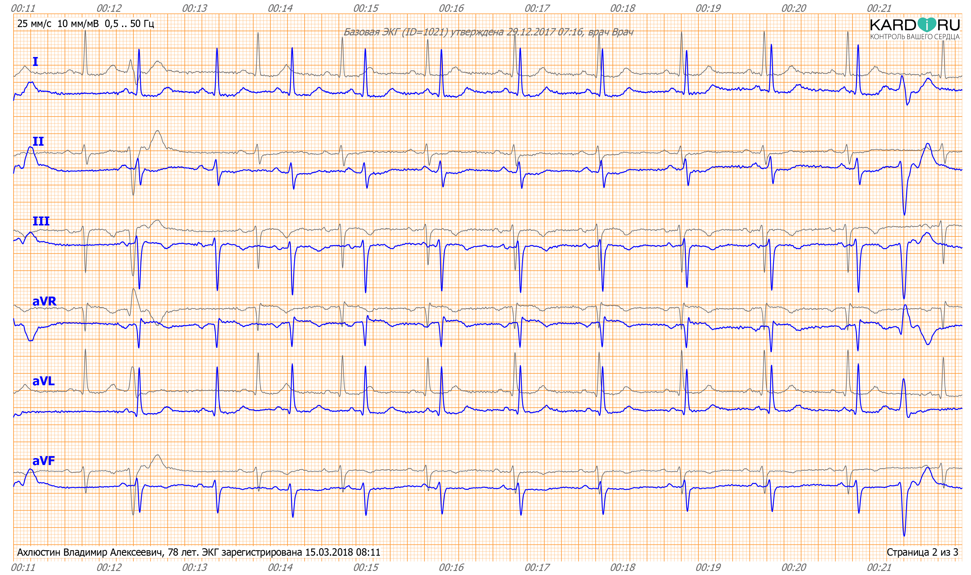 KardiRuConclusion-ECG-2.png