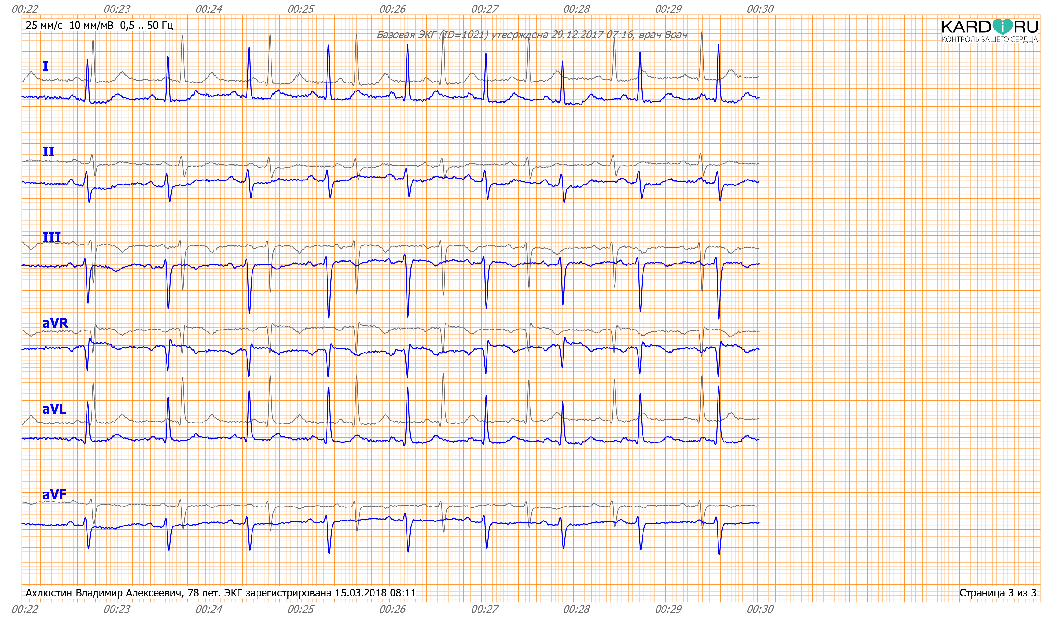 KardiRuConclusion-ECG-3.png